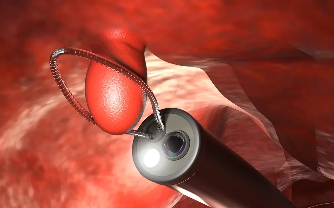 polipos de colon Las 5 opciones de rescate endoscopico que evitan la cirugia icadig