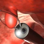 polipos de colon Las 5 opciones de rescate endoscopico que evitan la cirugia icadig