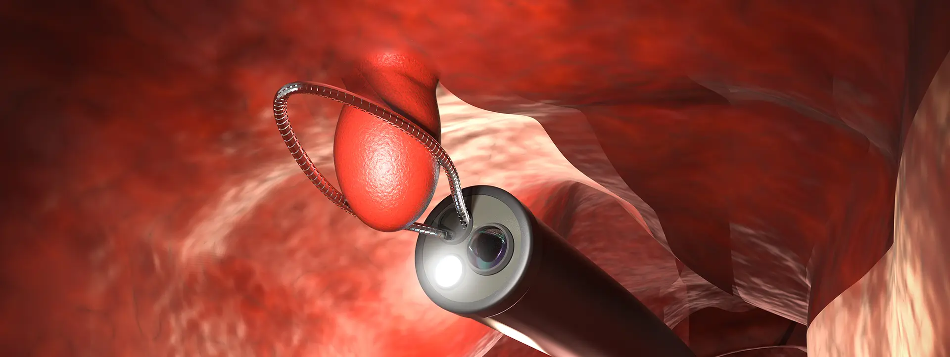 polipos de colon Las 5 opciones de rescate endoscopico que evitan la cirugia icadig